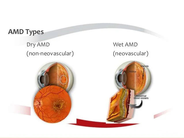 Age Related Macular Degeneration ARMD