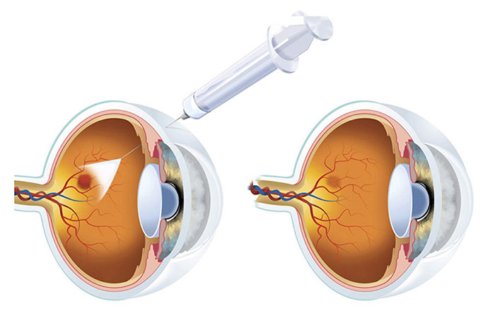 Intravitreal Injections Lucentis Avastin Etc