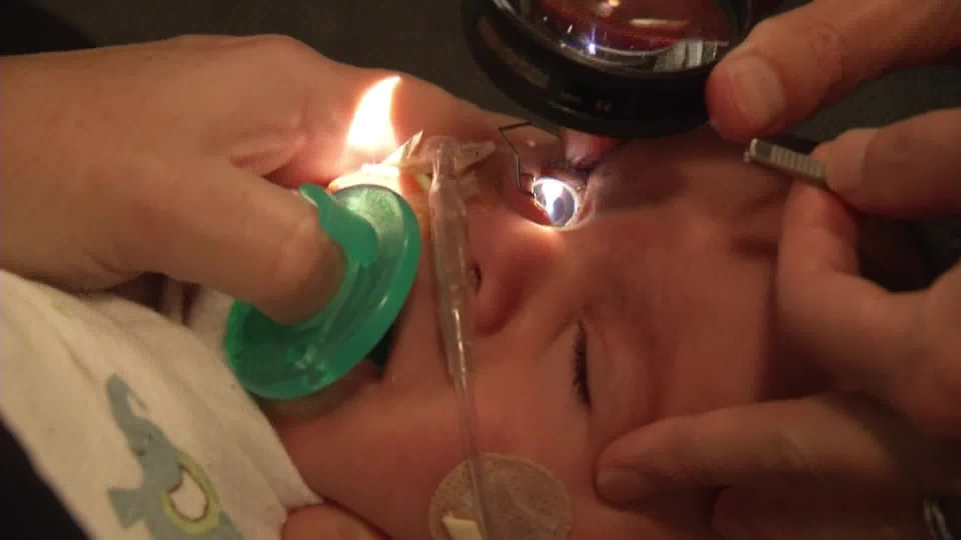 Laser Therapy For ROP