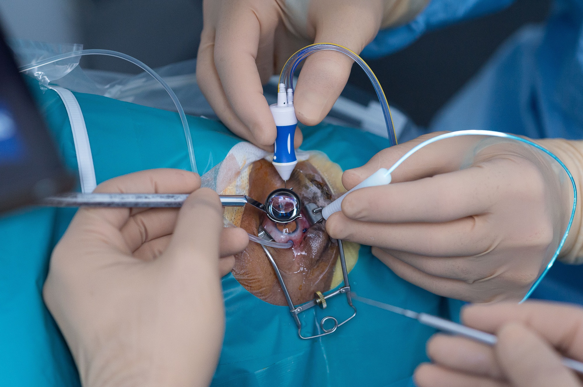 Retinal Detachment Surgery