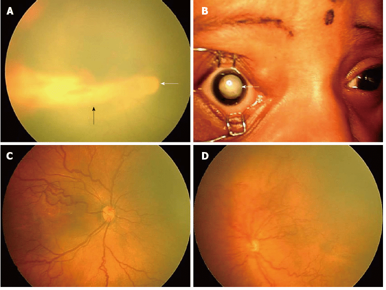 Retinal Imaging For Premature Infants
