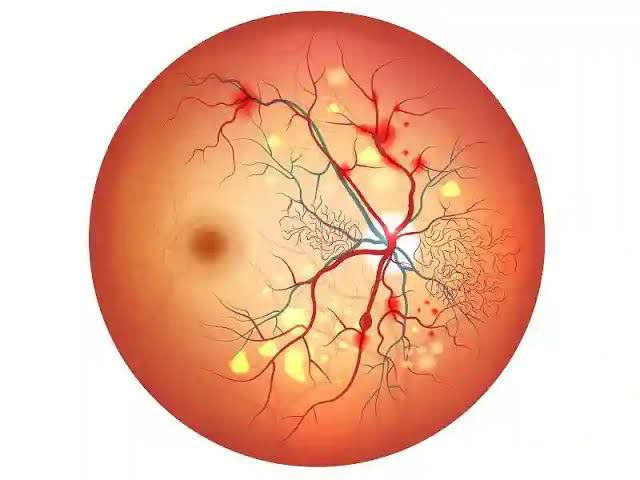 Diabetic Retinopathy Treatment