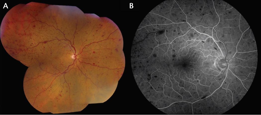 Retinal Vein Occlusion