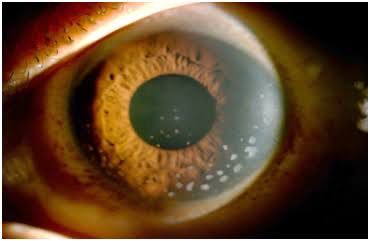 Best retina specialist in Indore