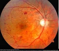 Best retina specialist in Indore