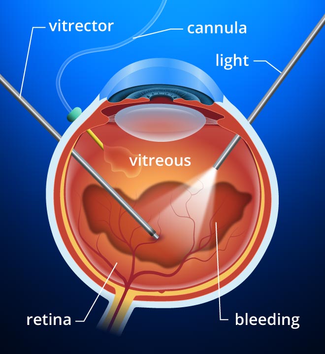 Retina Specialist in indore